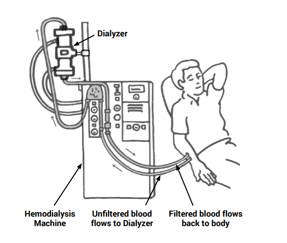 Hemodialysis Hemodialysis