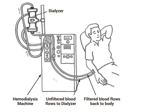 Een technisch diagram van een patiënt die hemodialyse ondergaat, met aanduidingen voor de dialysator, de hemodialysemachine en de stroom van ongefilterd en gefilterd bloed.